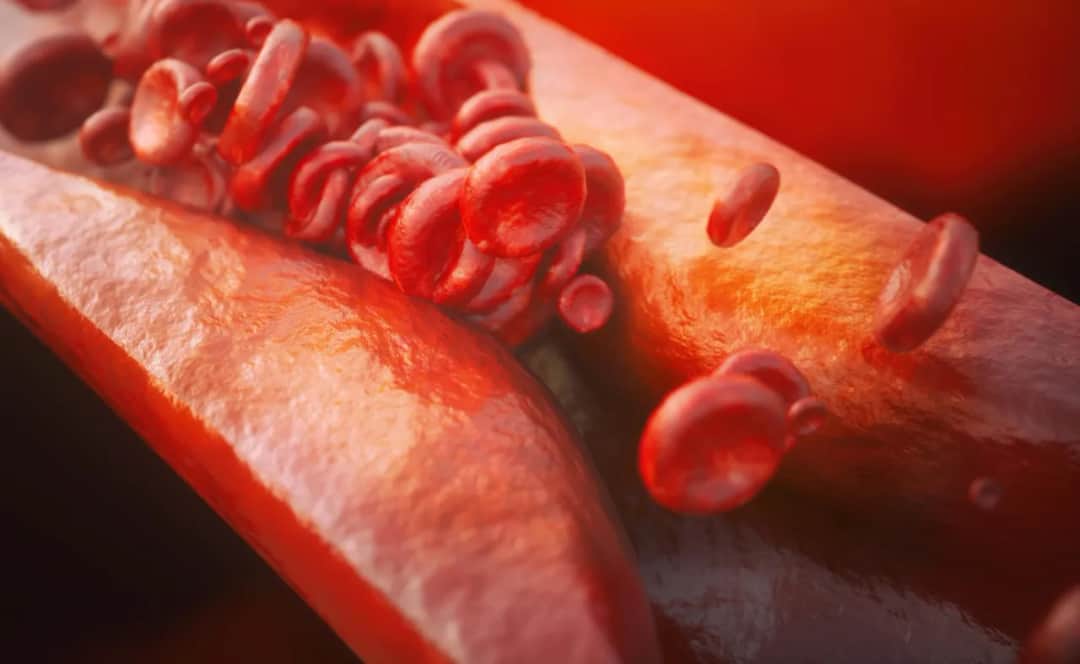 Czym grozi wysoki cholesterol? Poważne zagrożenia dla zdrowia
